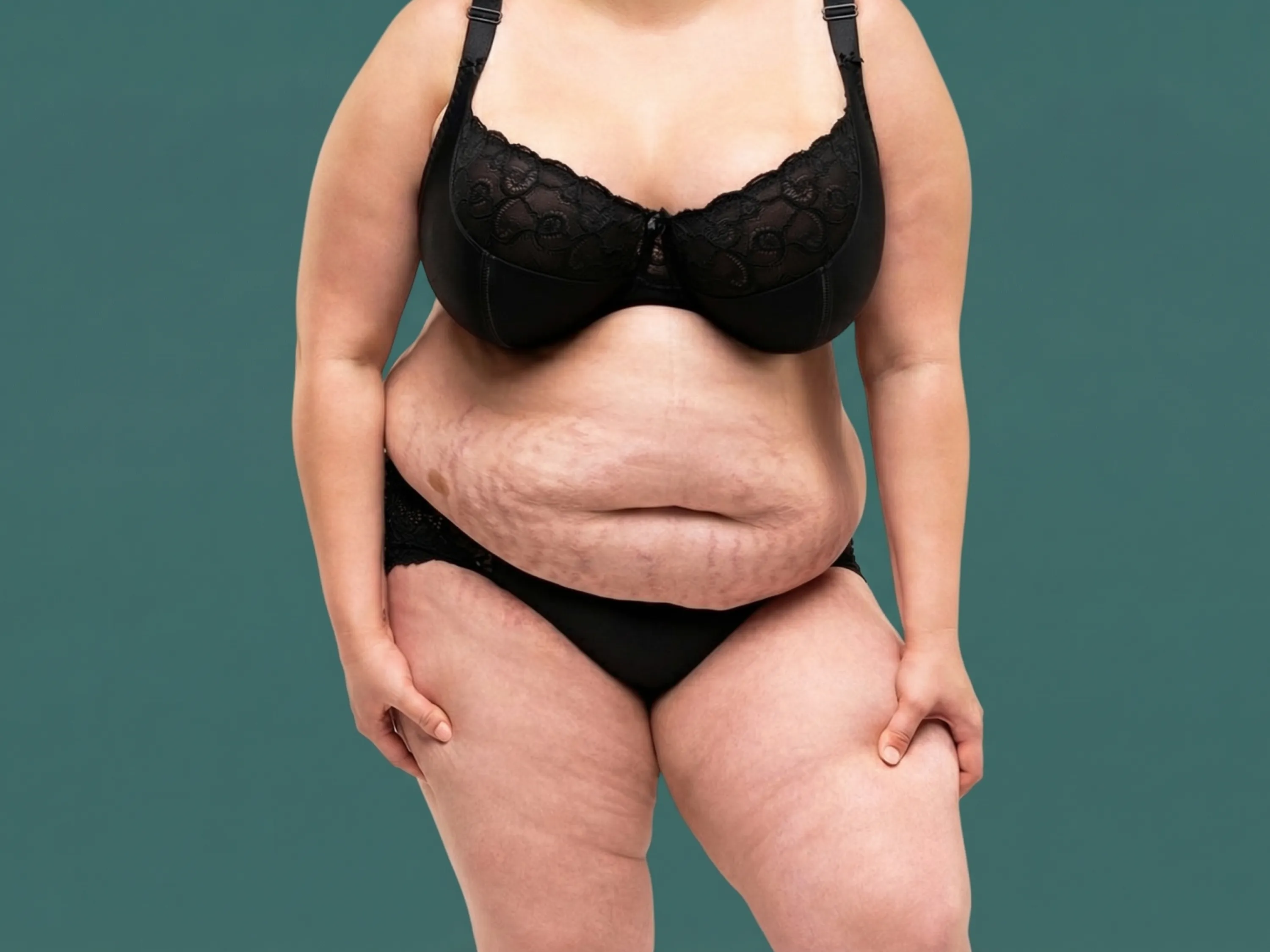 Hautprobleme bei Übergewicht sichtbar an Bauch und Hautfalten
