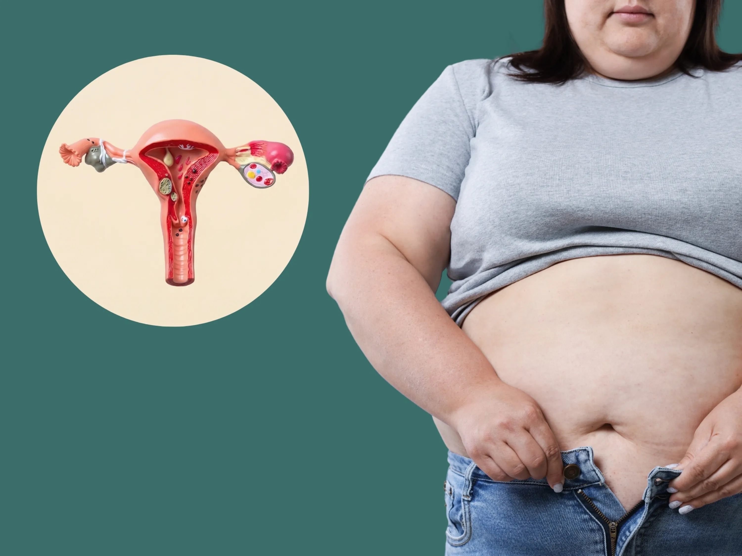 Symbolbild zu Endometriose und Gewichtszunahme: Frau mit zu enger Jeans neben Gebärmutter-Illustration.