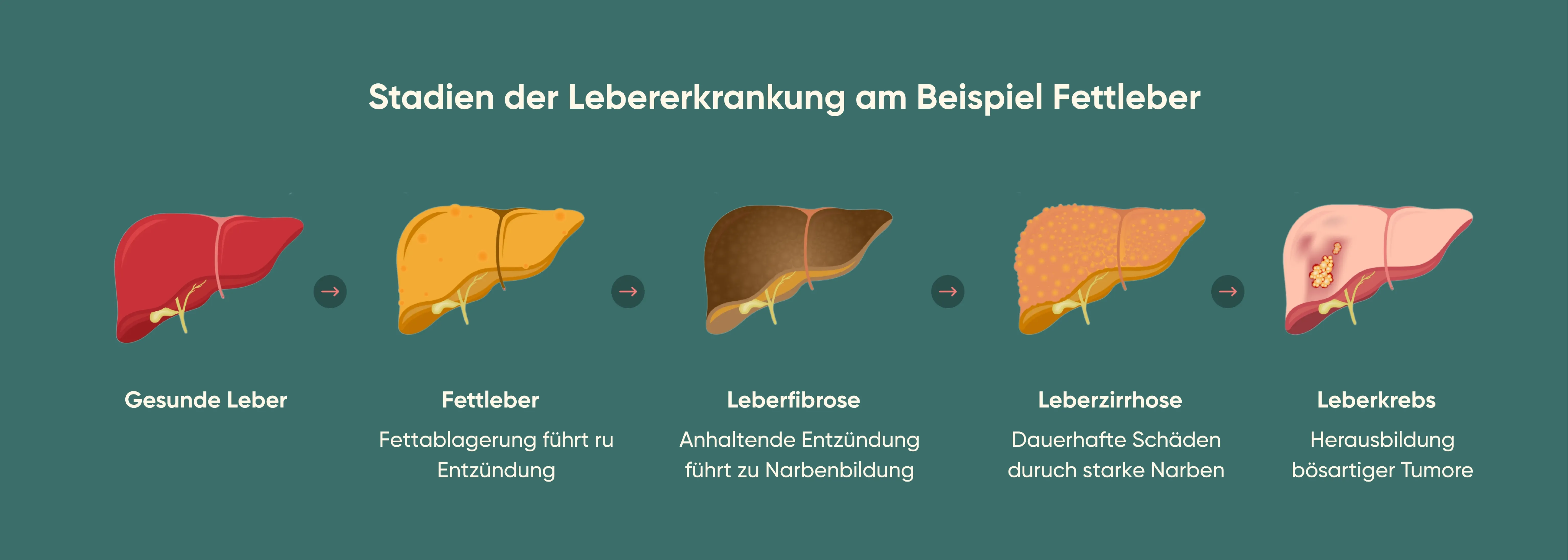 Infografik zu den Stadien der Lebererkrankung mit Fokus auf Fettleber, dargestellt von gesunder Leber über Fettleber und Leberfibrose bis hin zu Leberzirrhose und Leberkrebs.