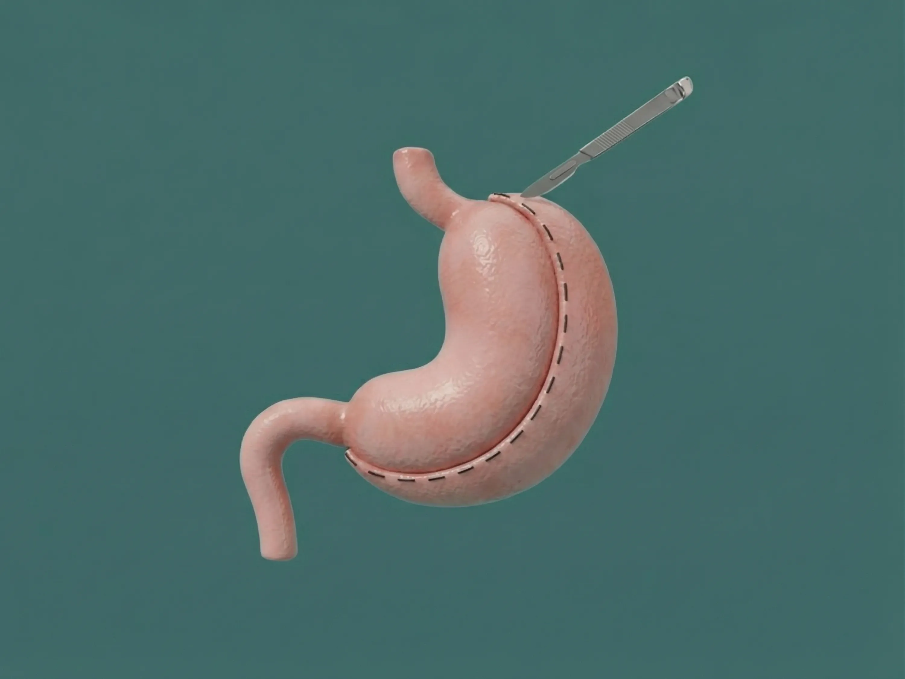 Medizinische Illustration eines verkleinerten Magens nach einer Schlauchmagen Operation, die zur Gewichtsreduktion eingesetzt wird.