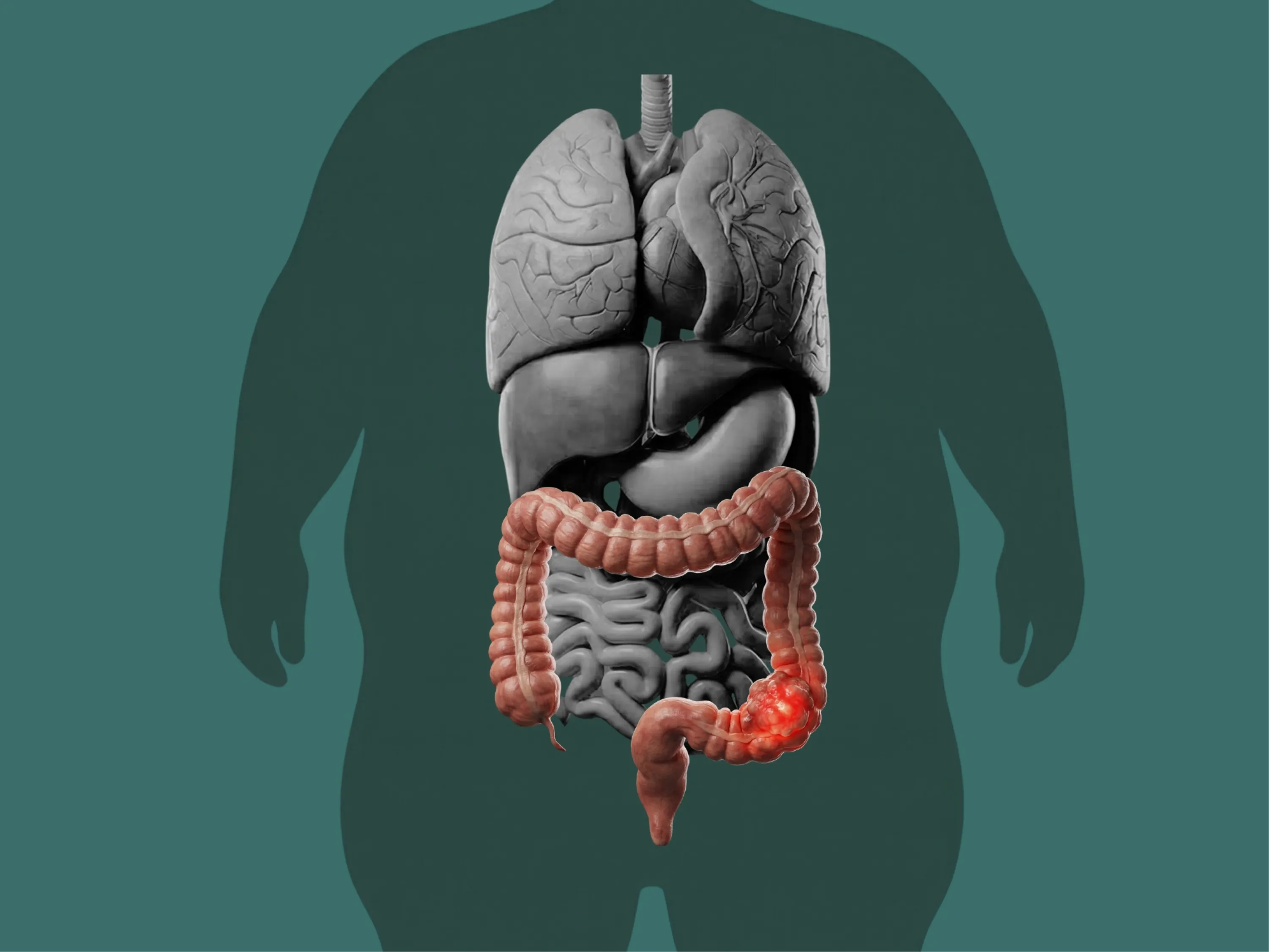 Anatomische Darstellung des Darms mit markiertem Bereich zu Darmkrebs im übergewichtigen Körpermodell.