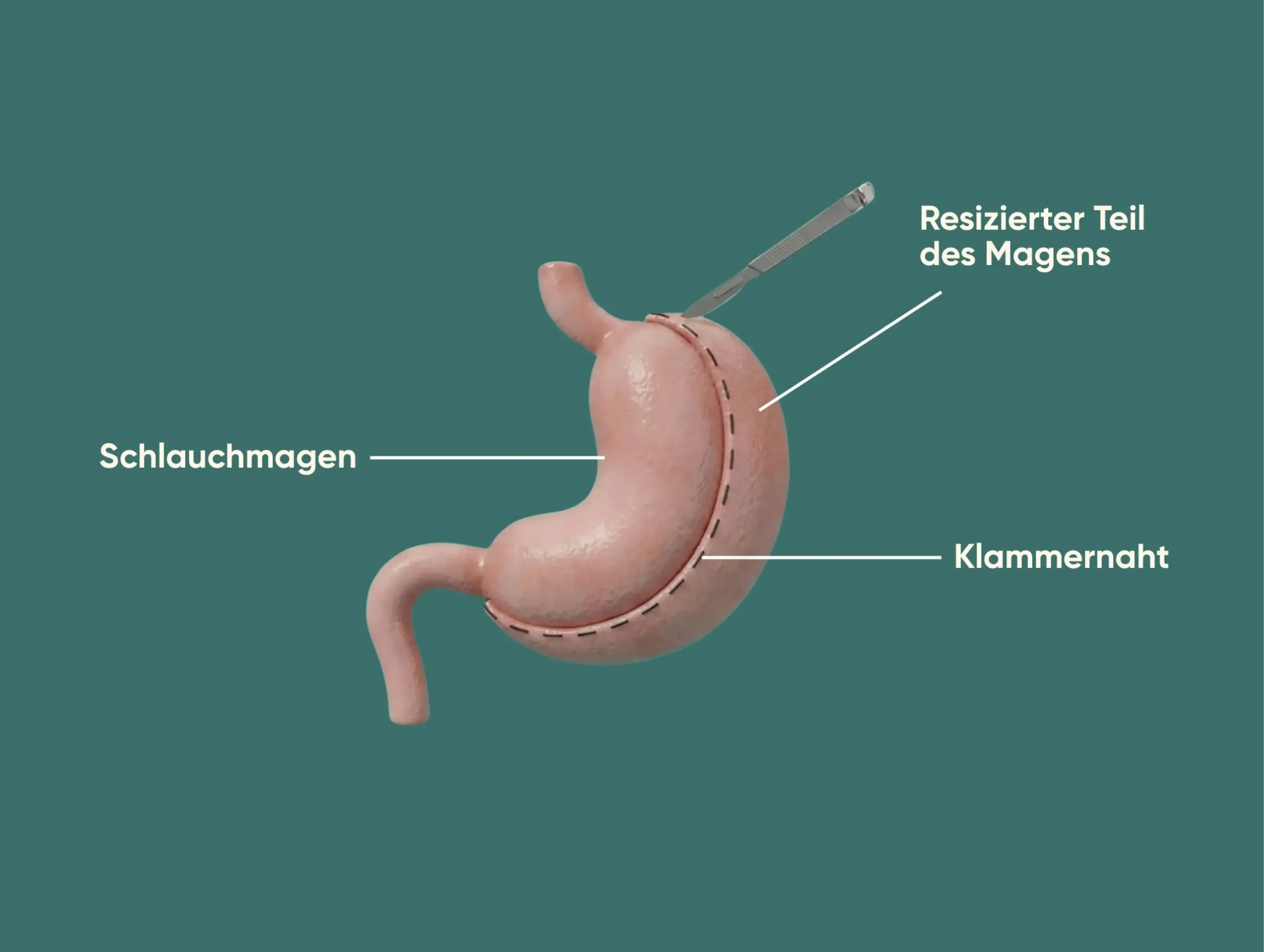 Grafische Darstellung eines Schlauchmagen-Eingriffs, bei dem der Magen zu einem schmalen Schlauchmagen geformt und der entfernte Teil markiert ist.