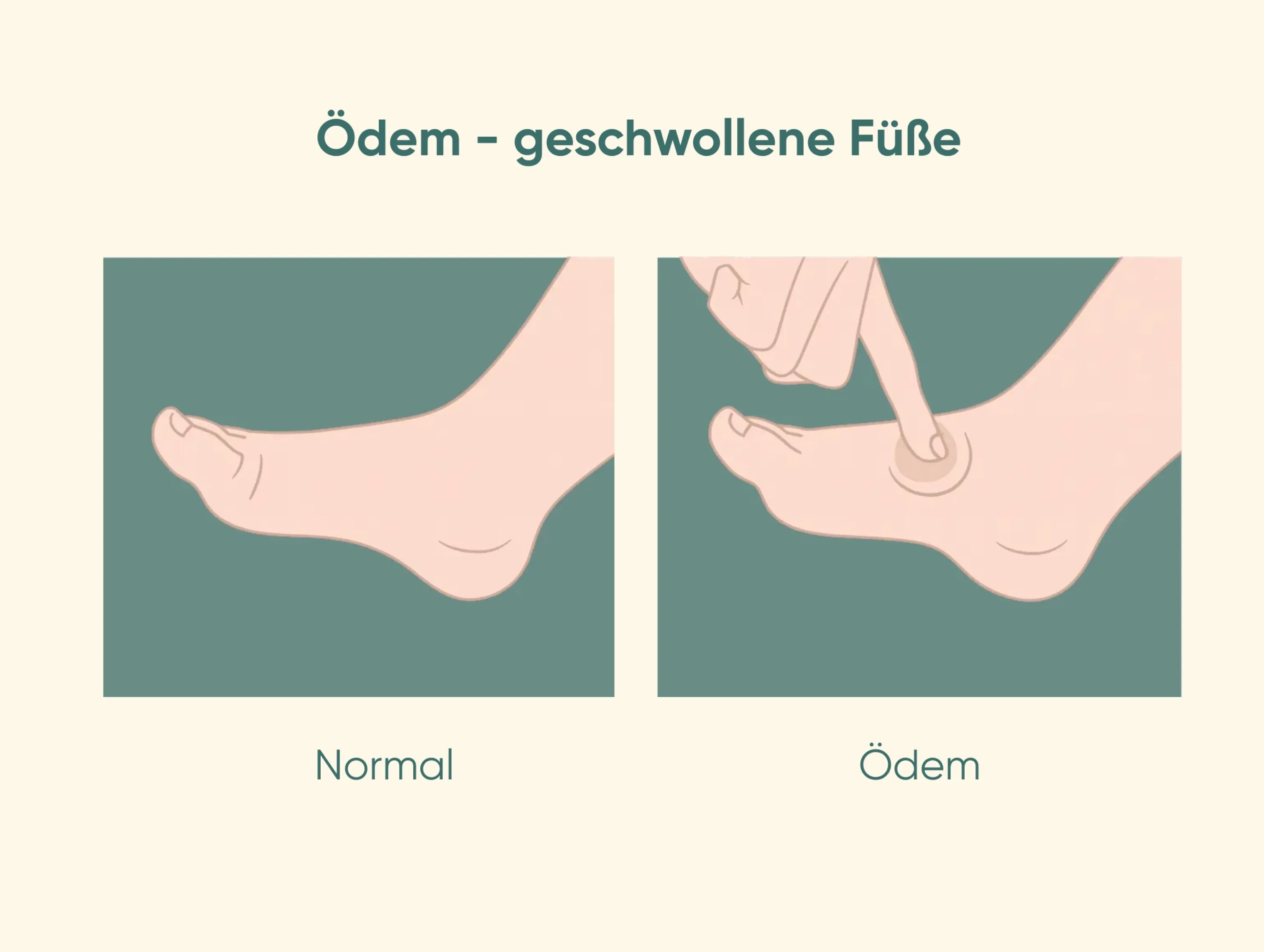 Grafische Darstellung eines normalen Fußes und eines geschwollenen Fußes mit Ödem, die zeigt, wie Abnehmen Wassereinlagerungen im Körper reduzieren kann.