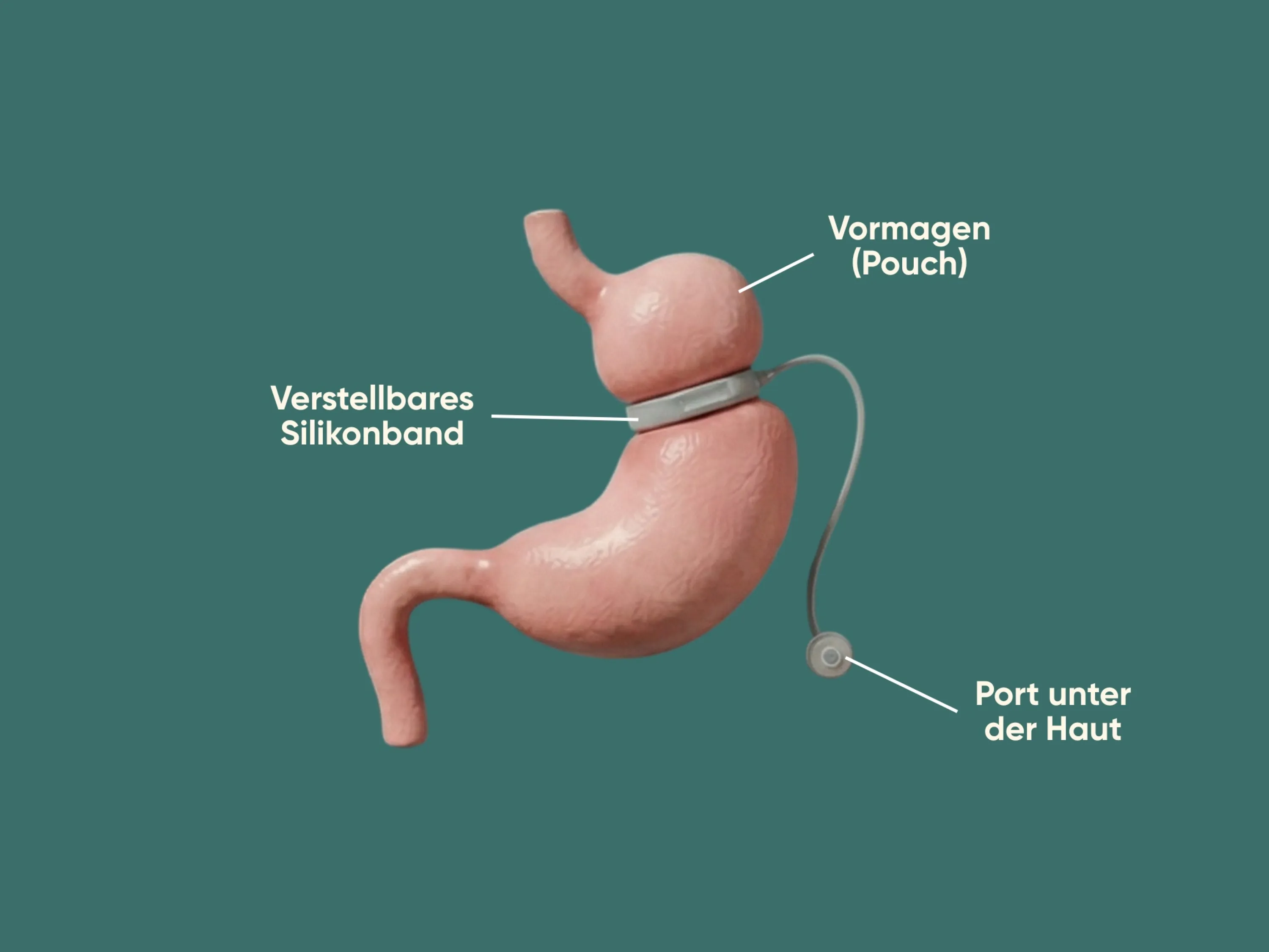Infografik zum magenband mit Darstellung von Vormagen (Pouch), verstellbarem Silikonband und Port unter der Haut zur operativen Behandlung von starkem Übergewicht.