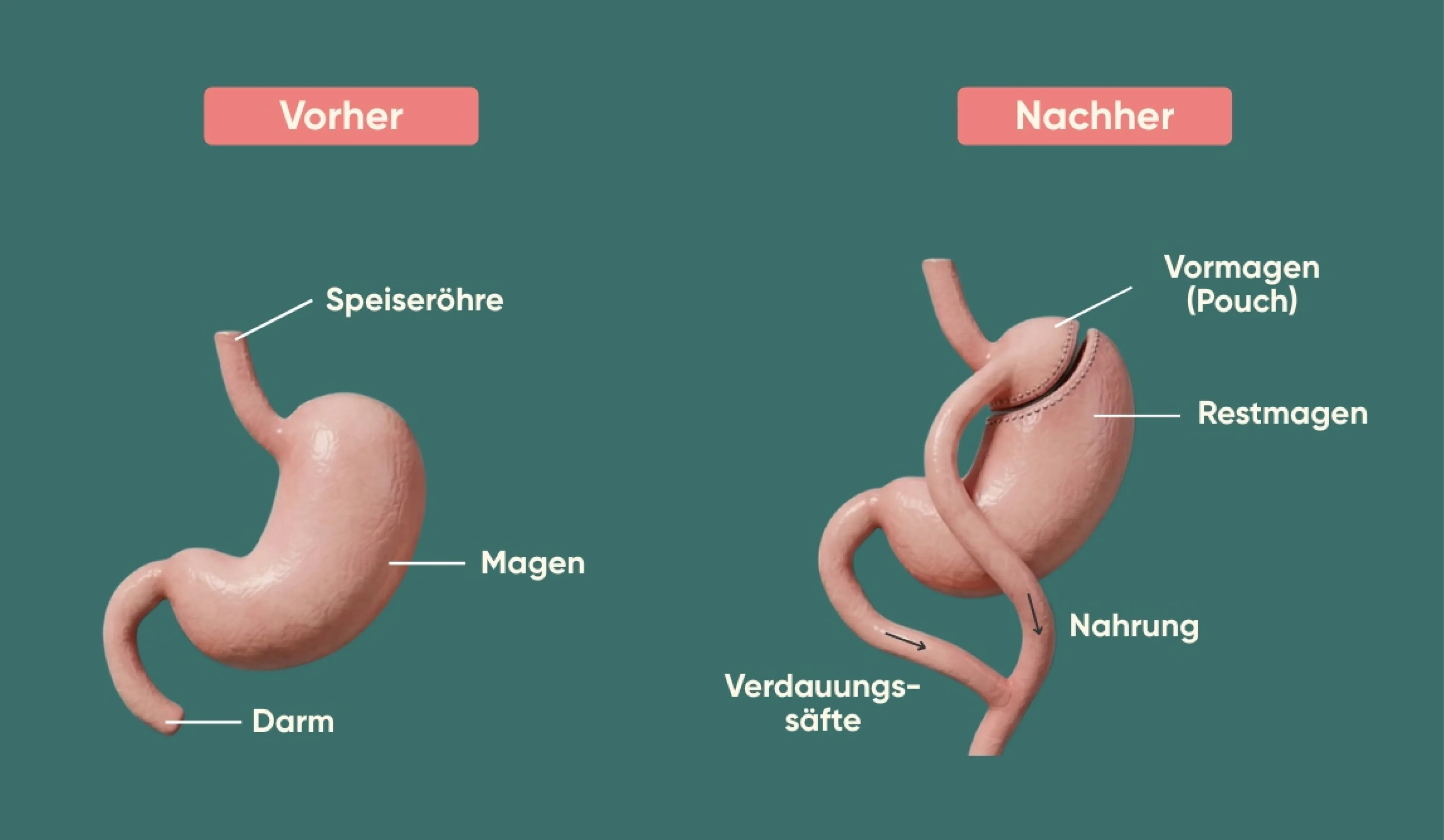 Infografik zum Magenbypass mit Vergleich von Magen und Verdauung vor und nach der Operation, inklusive Vormagen (Pouch), Restmagen und verändertem Nahrungsweg.