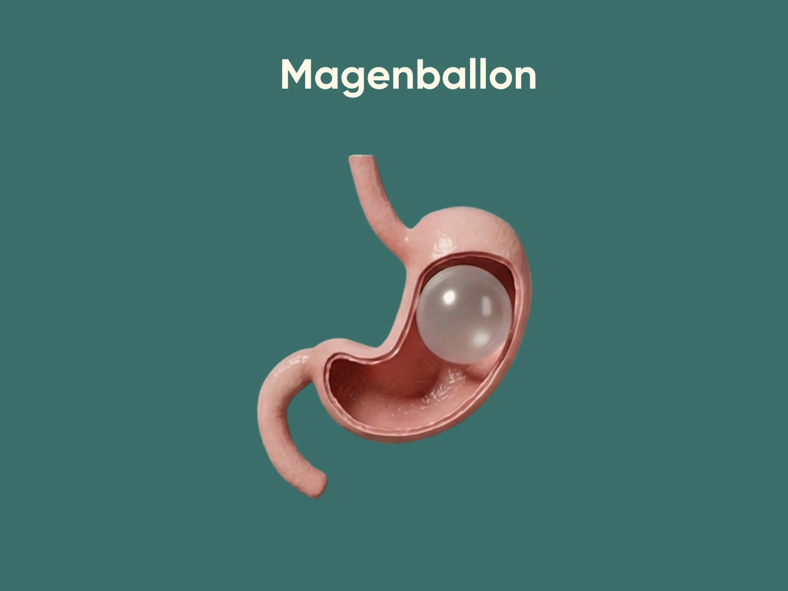 Illustration eines eingesetzten Magenballons im Magen, die zeigt, wie der Magenballon den verfügbaren Platz reduziert und so das Sättigungsgefühl beeinflusst.