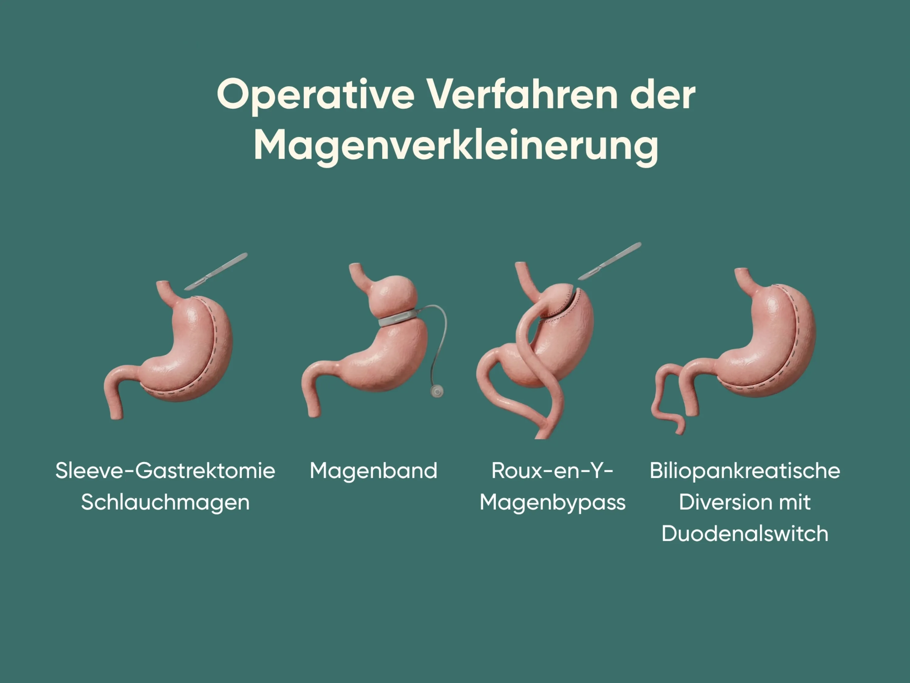 Grafische Übersicht verschiedener chirurgischer Verfahren der Magenverkleinerung, die die gängigen Operationsmethoden zur Magenverkleinerung anschaulich nebeneinander darstellt.