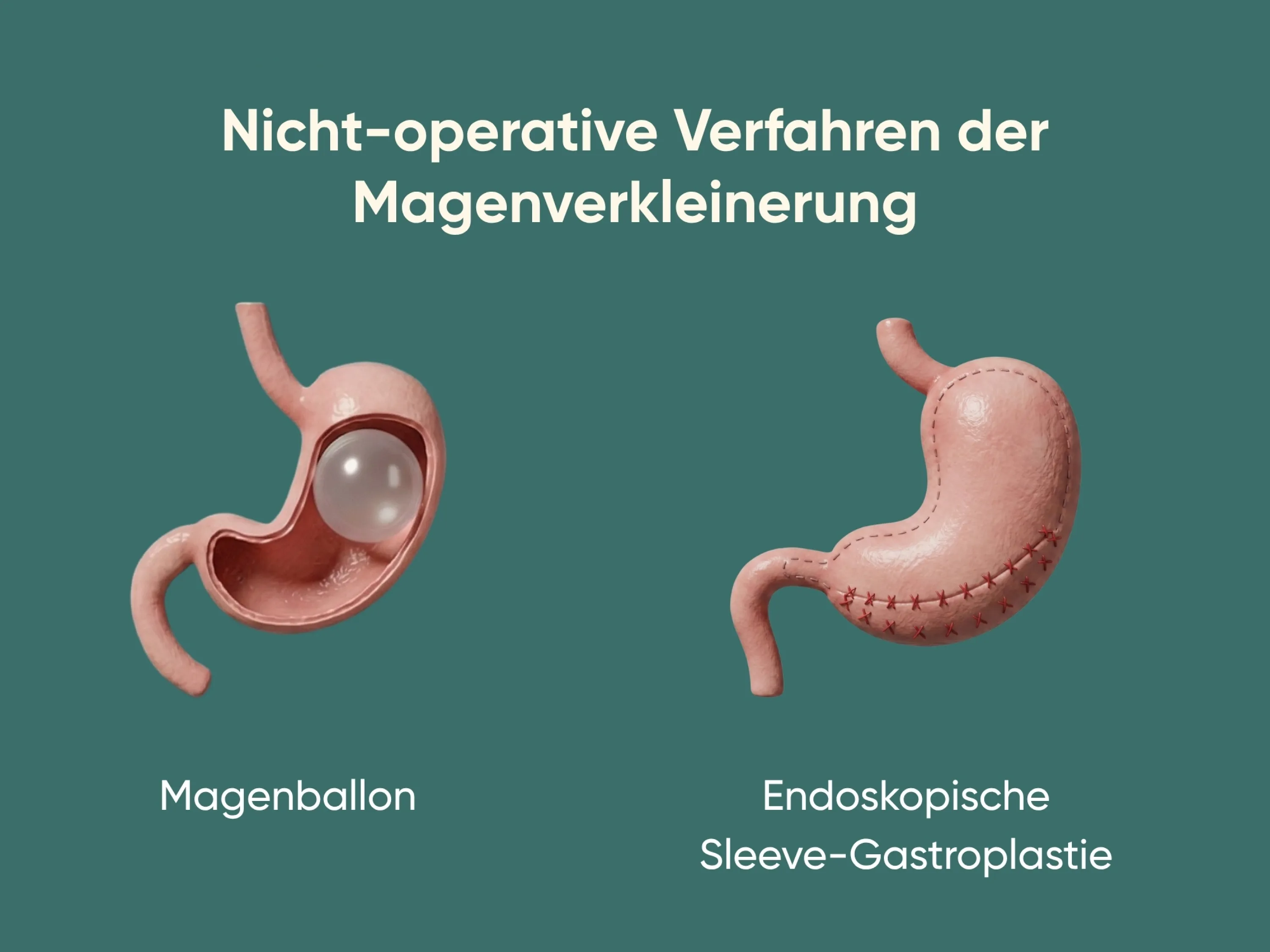 Illustration nicht-operativer Methoden der Magenverkleinerung mit Darstellung eines Magenballons und einer endoskopischen Sleeve-Gastroplastie.