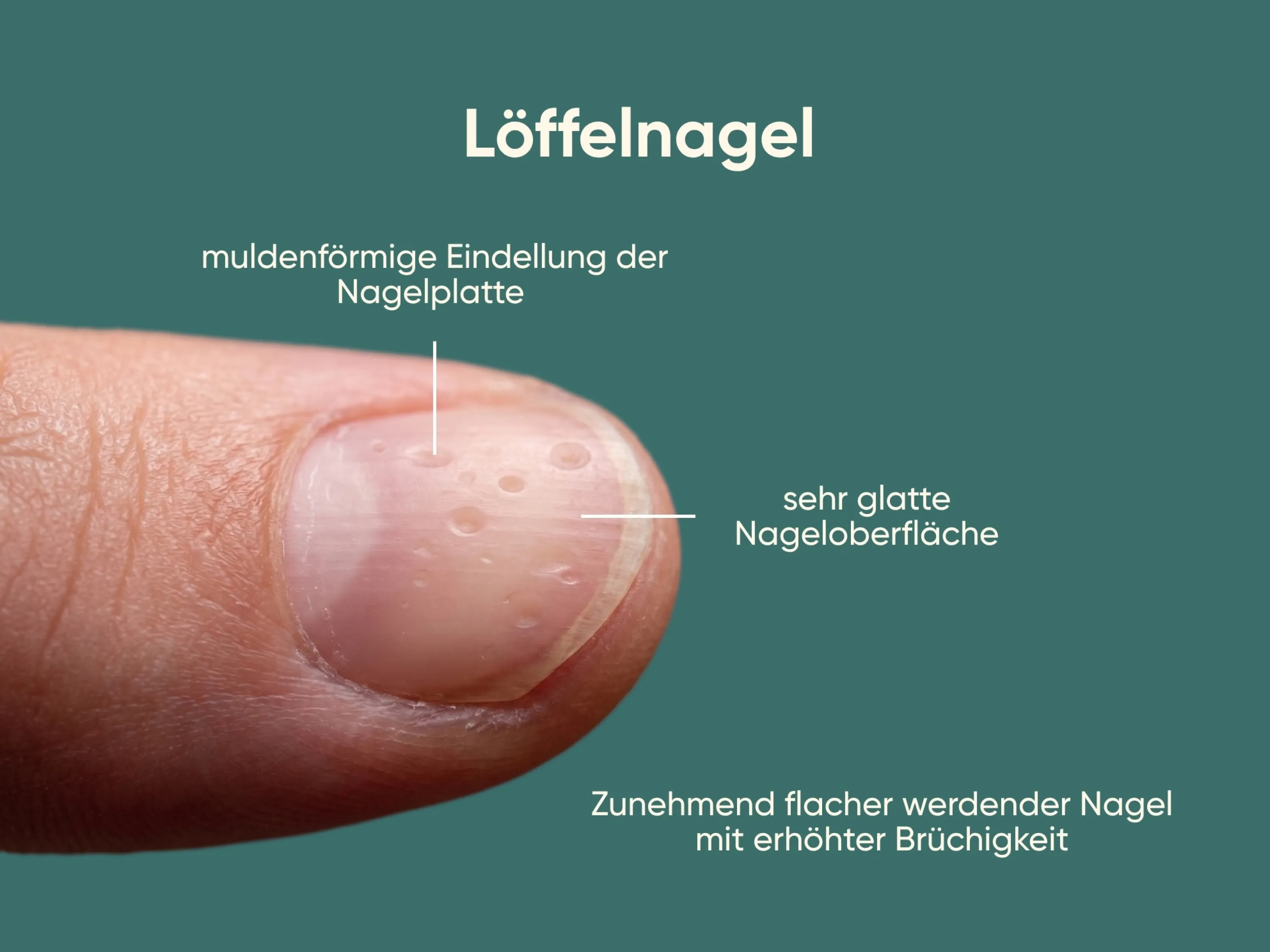 Infografik eines Löffelnagels mit sehr glatter, muldenförmig eingedellter Nagelplatte und erhöhter Brüchigkeit als mögliche Folge bei Eisenmangel .