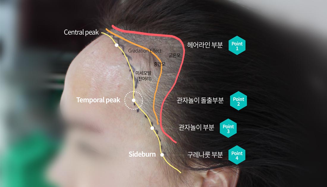 강남 드림헤어라인모발이식 - 4D 페이스 헤어라인 교정
