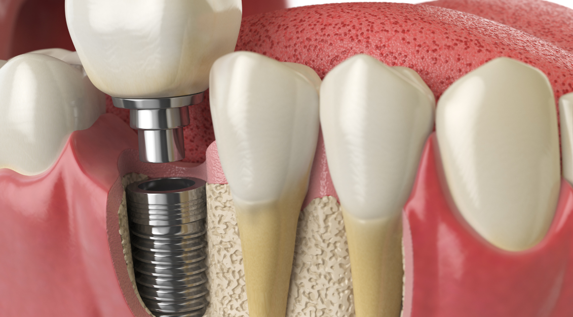¿Puedo tener implantes con pérdida ósea? Soluciones, Limitaciones y Éxito