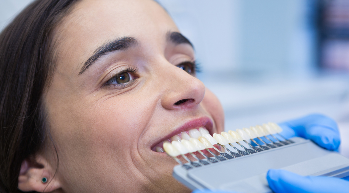 Bonding Dental vs. Carillas: Diferencias Clave, Ventajas y Desventajas