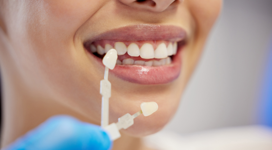 Zoom Whitening Before and After: Results, Procedure, and Care