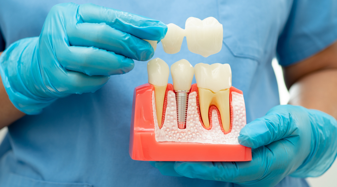 Implant vs Bridge Pros and Cons: Choosing the Best Solution