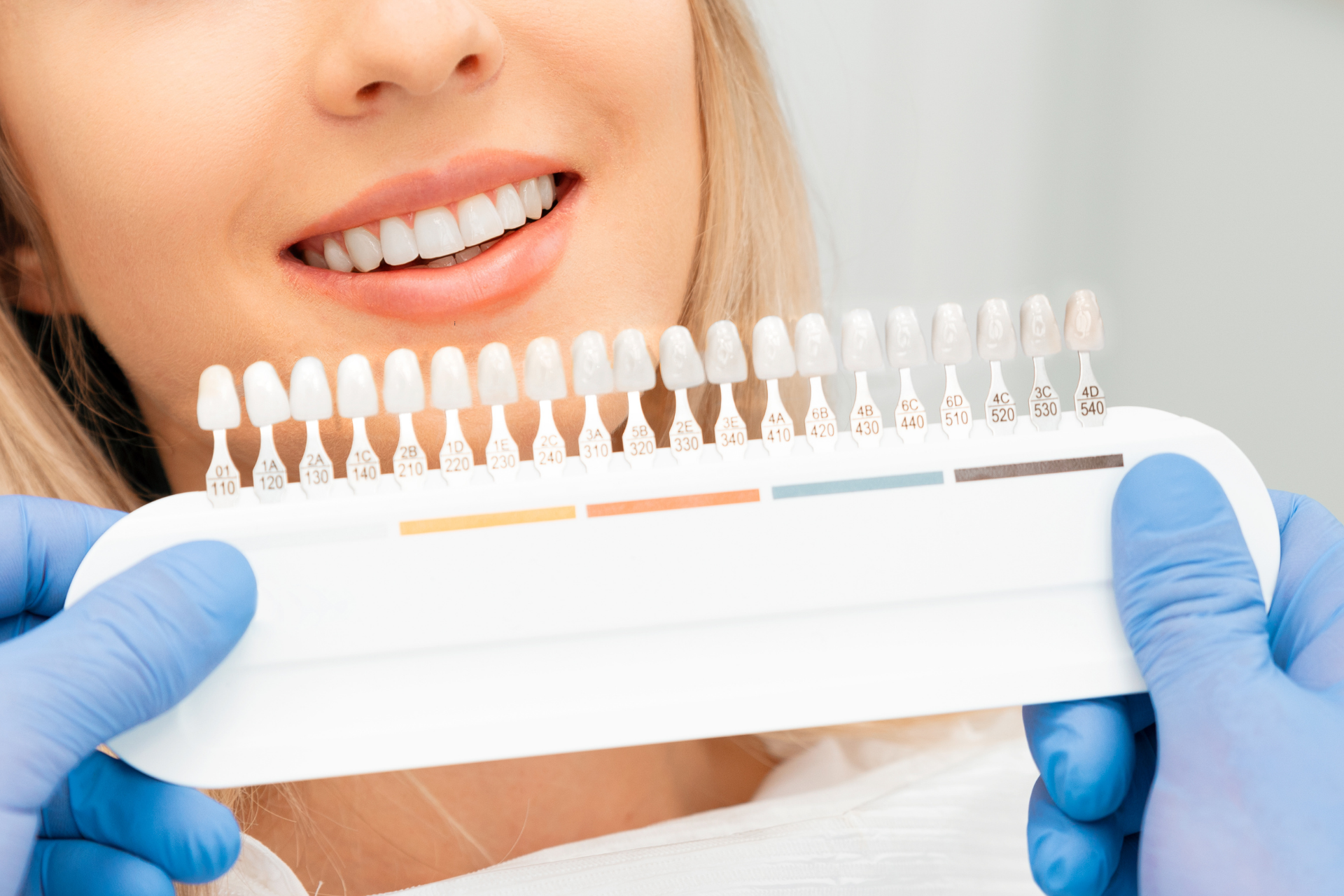 Veneers