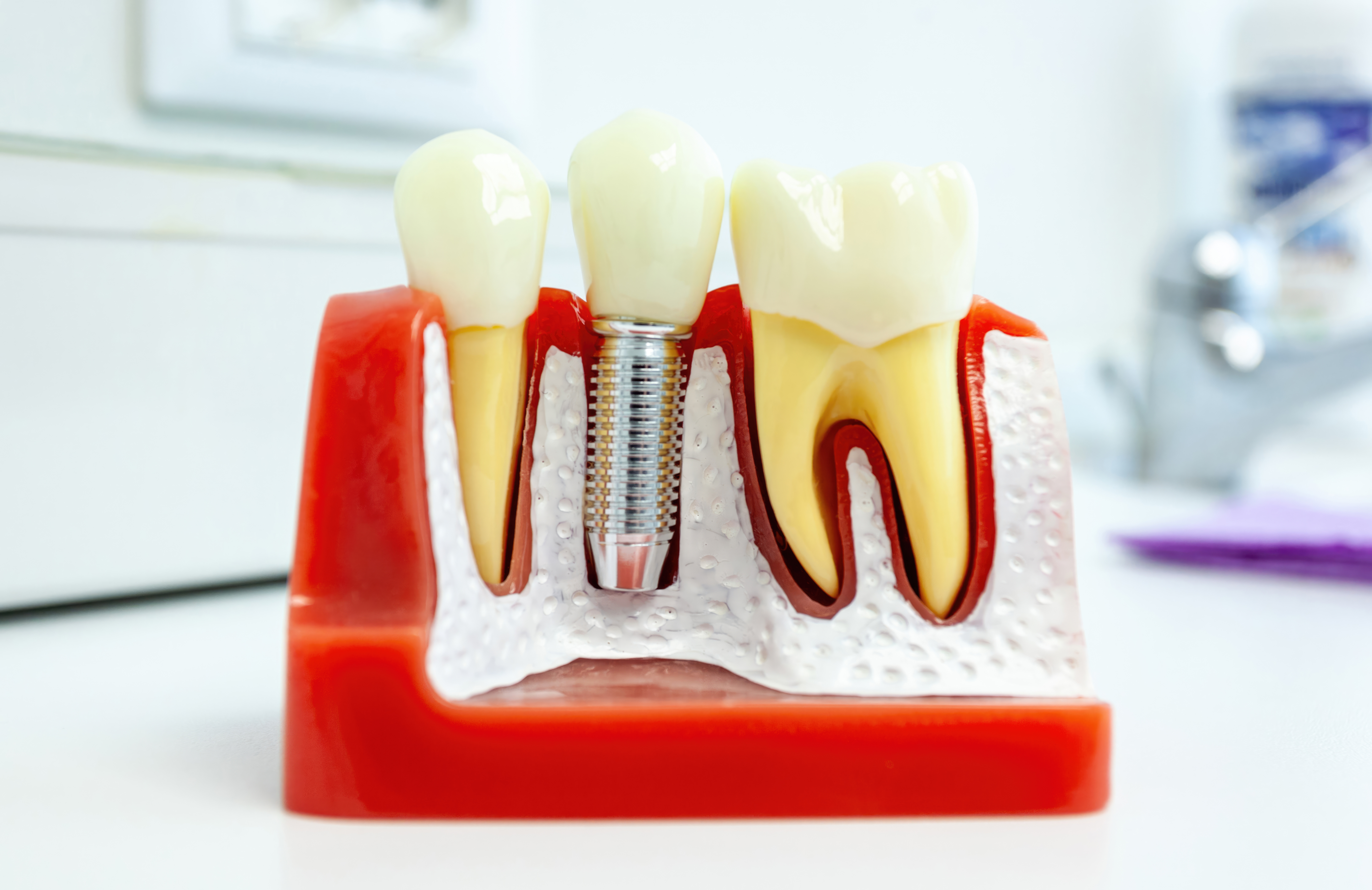 Bone Graft for Dental Implant: Why It Matters for a Strong, Lasting Smile