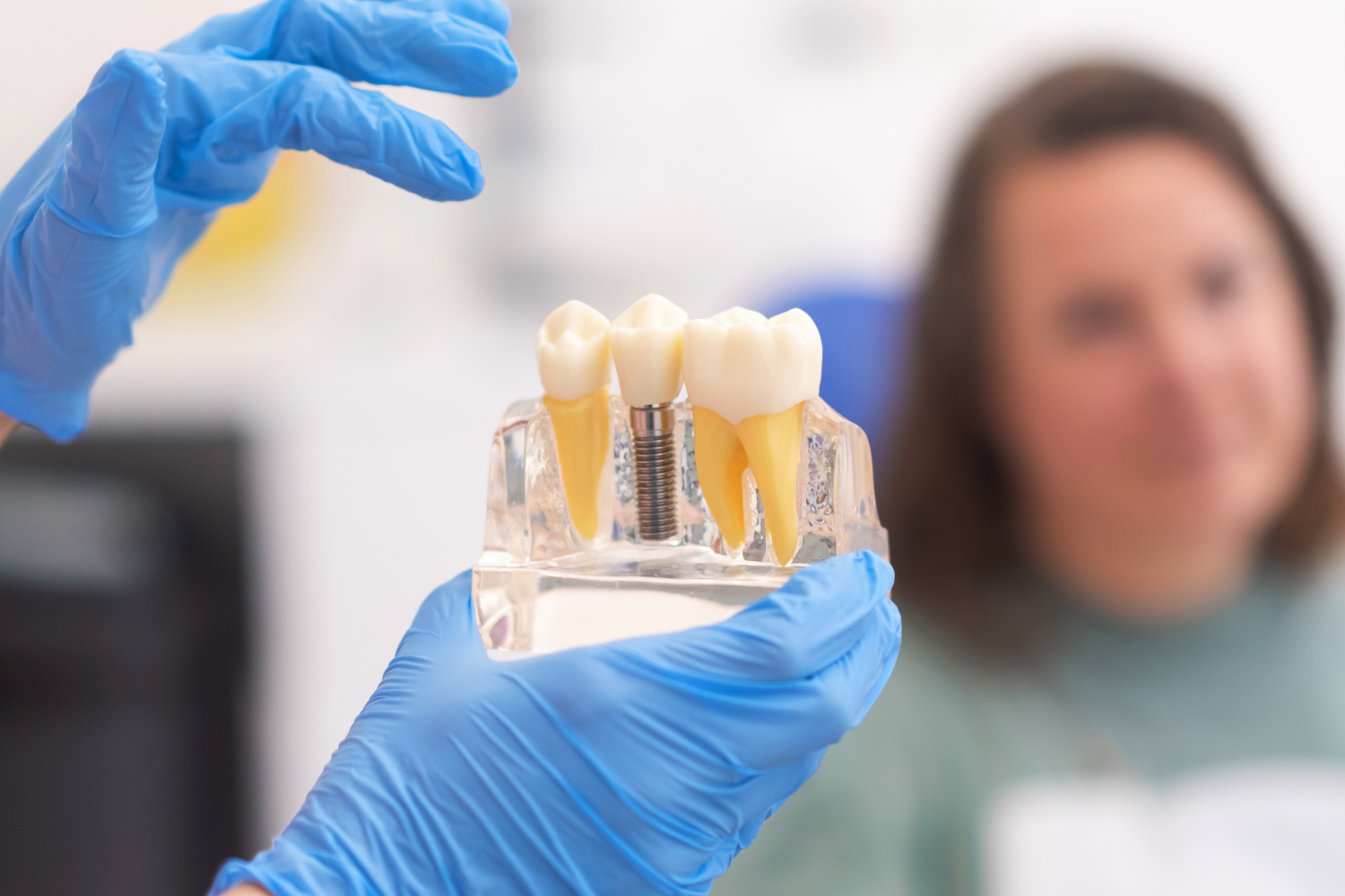 Comparación de costos de implantes dentales frente a dentaduras postizas completas: una guía completa de costos y valor