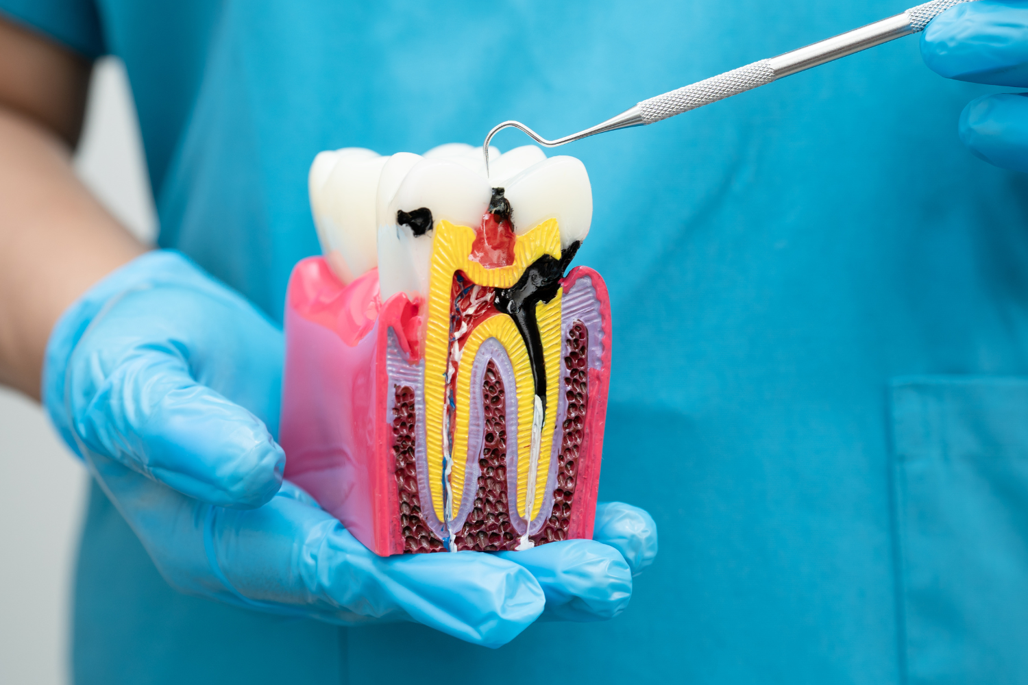 How Long Does a Root Canal Last? Factors and Proven Ways to Extend Its Lifespan