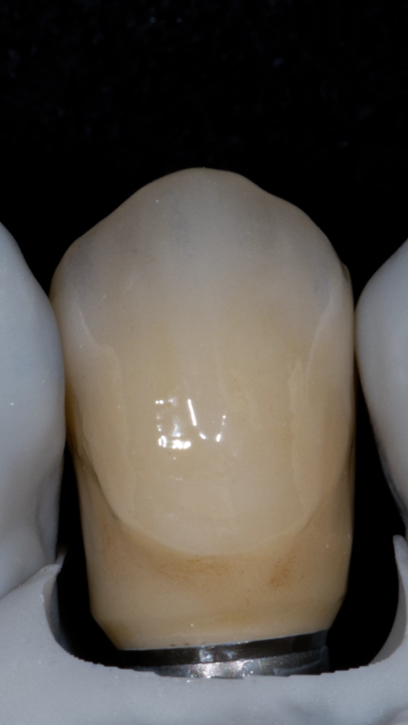 Vollzirkon Krone Individuell Bemalt auf Implantat verklebt auf Titanbasis.