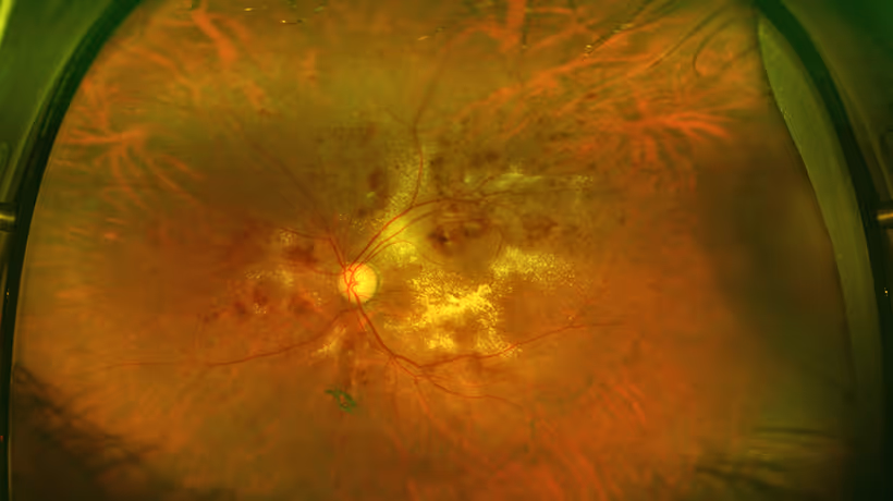 An eye with severe diabetic retinopathy captured on Optos
