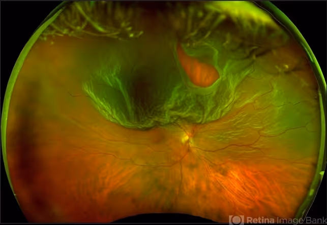 Retinal hole and detachment graphic