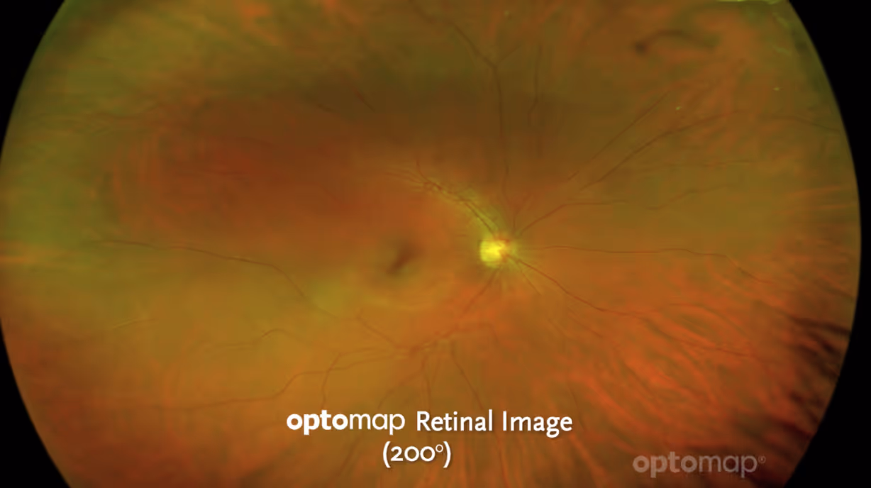 Optomap Retinal Image