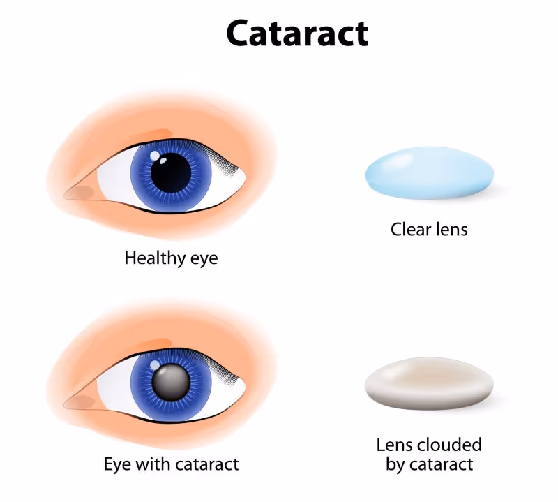 Cataract eye infographic