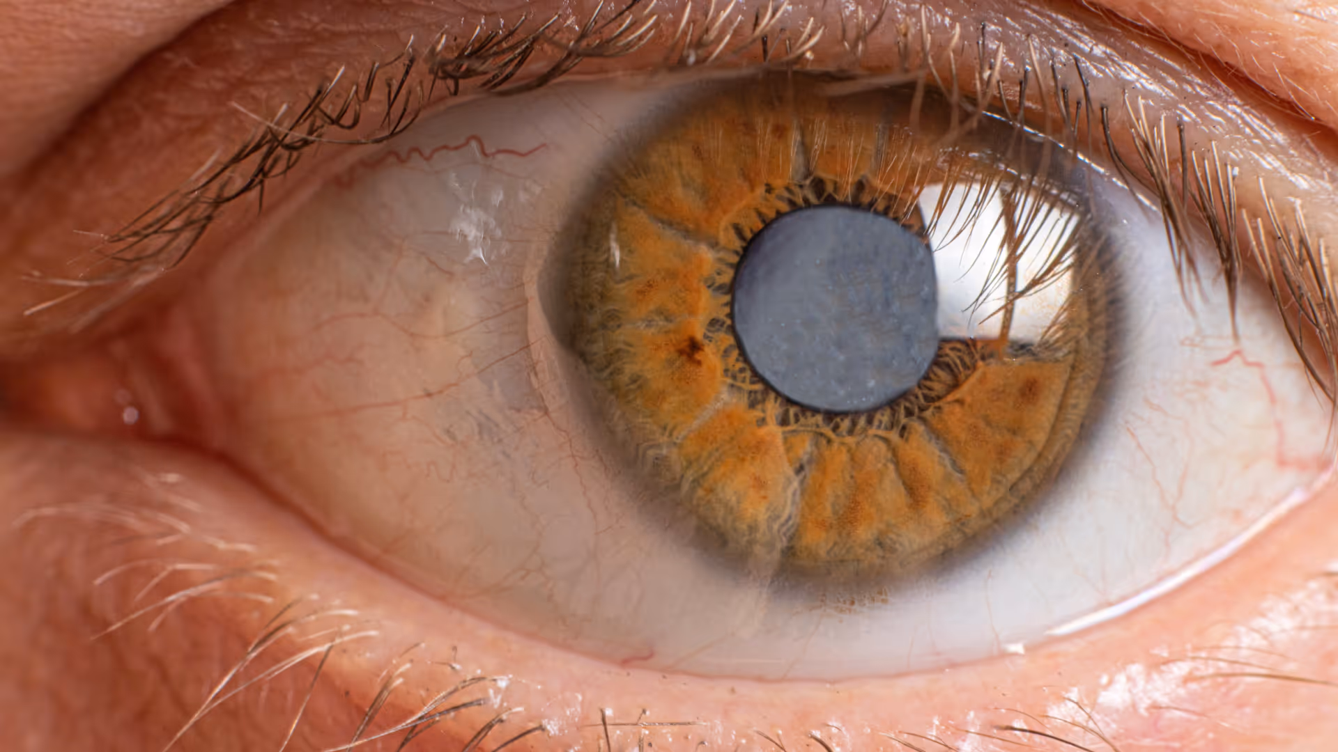 Close up of eye cataract