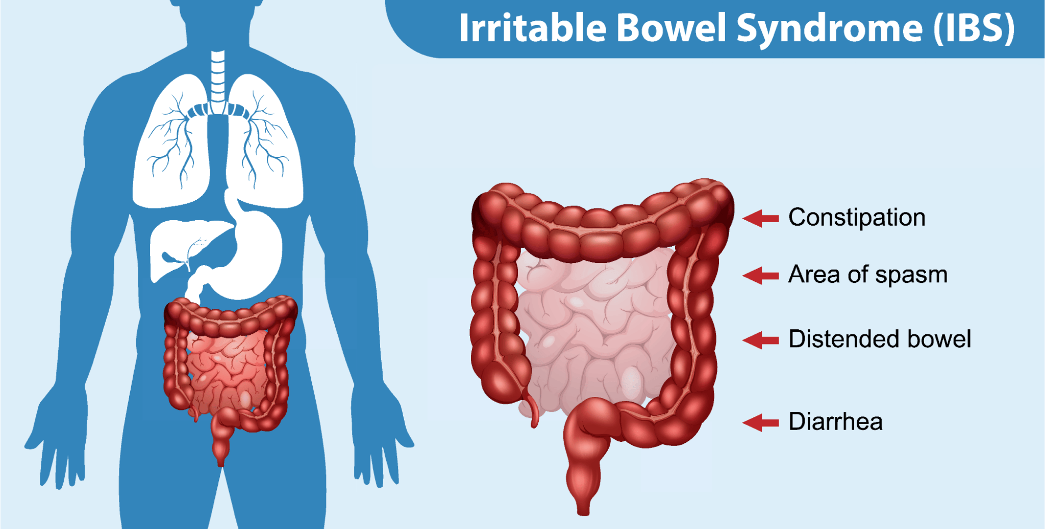 Drawing of the digestive system with various symptoms of IBS