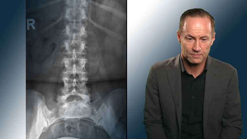 Axiale Spondyloarthritis (AxSpA)