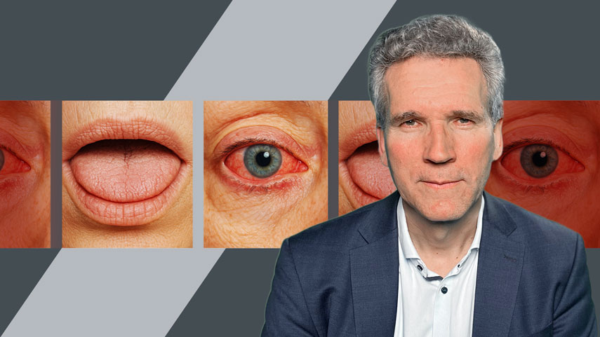 Sjögren-Syndrom kompakt: Zuverlässig erkennen und erfolgreich therapieren