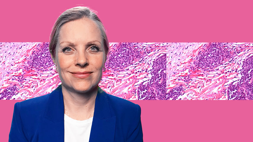 BPDCN - Blastische plasmazytoide dendritische Zellneoplasie