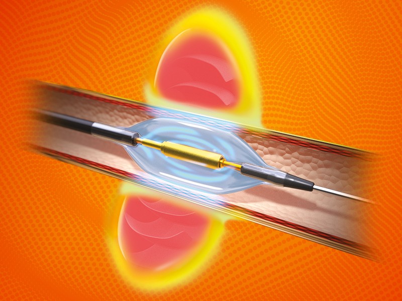 Bild eines Ultraschall Katheter