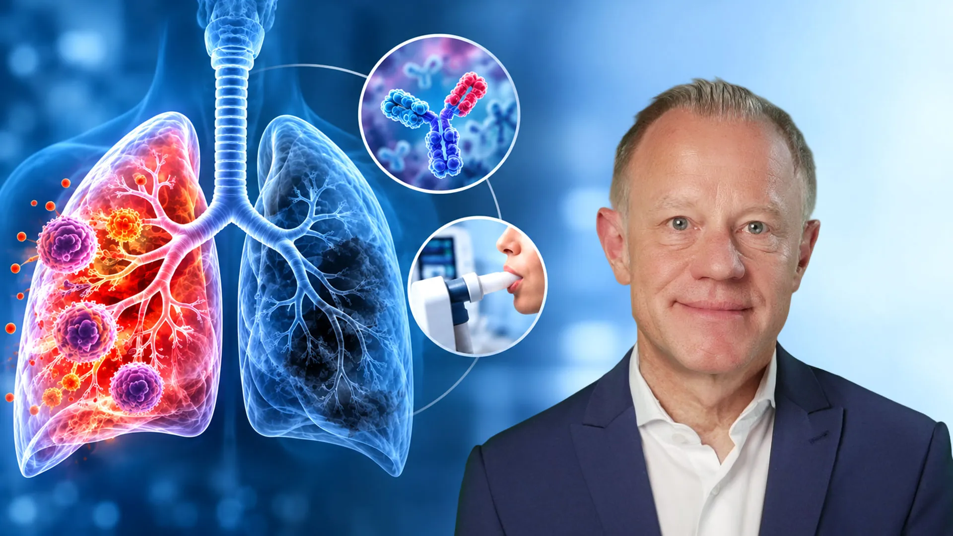 Nanobody-Technologie & Biologika in der COPD-Therapie: Neue Horizonte für High-Risk-Patient