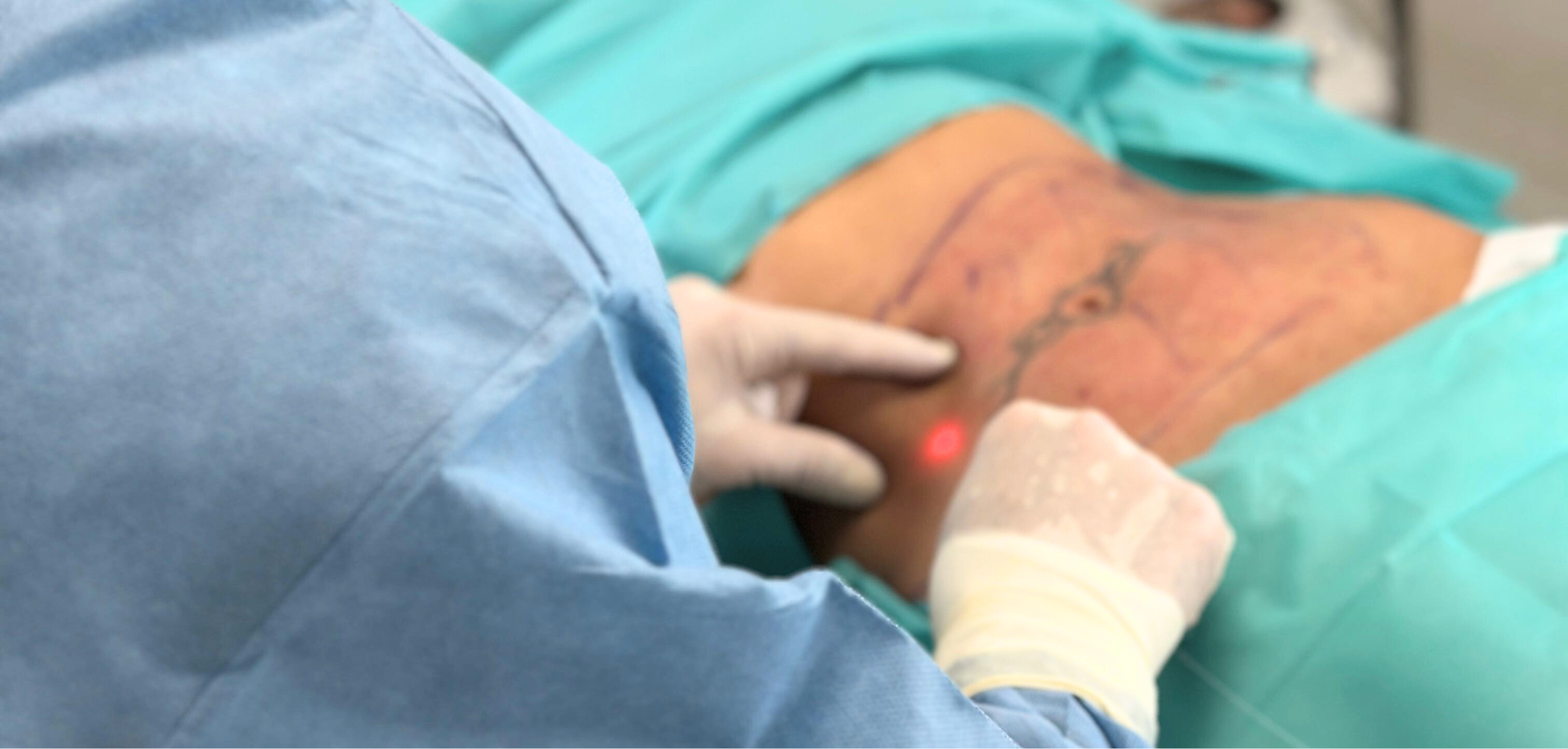 Endolaser Lifting | Hautstraffung & Fettreduktion