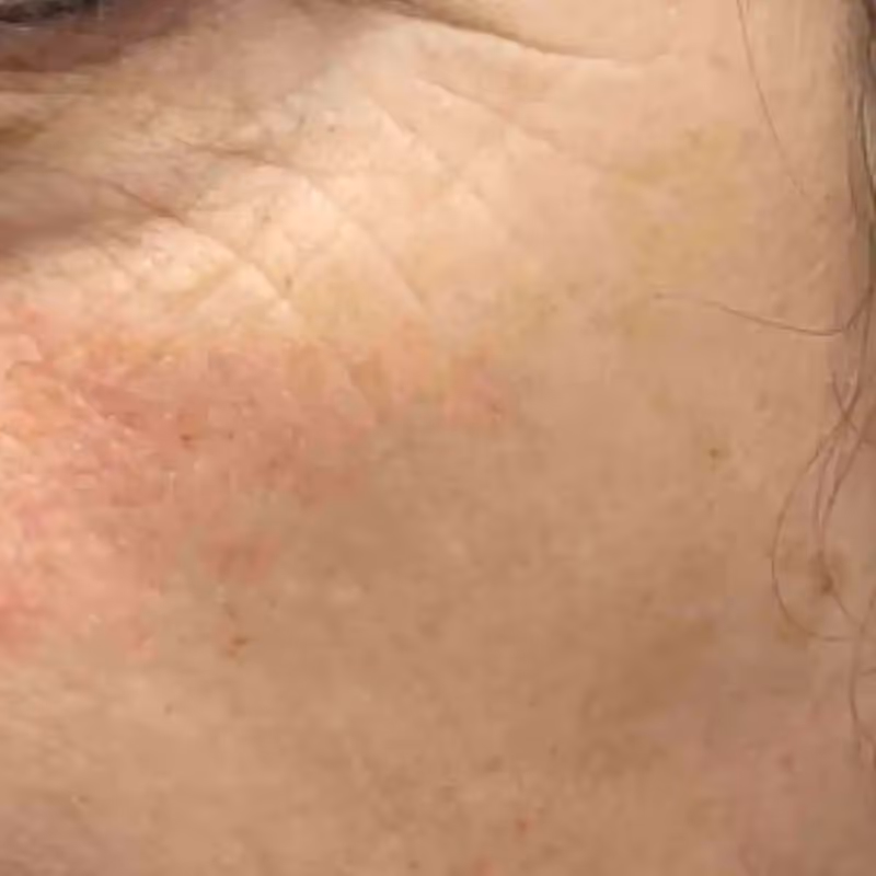 SKIN PEN 2
