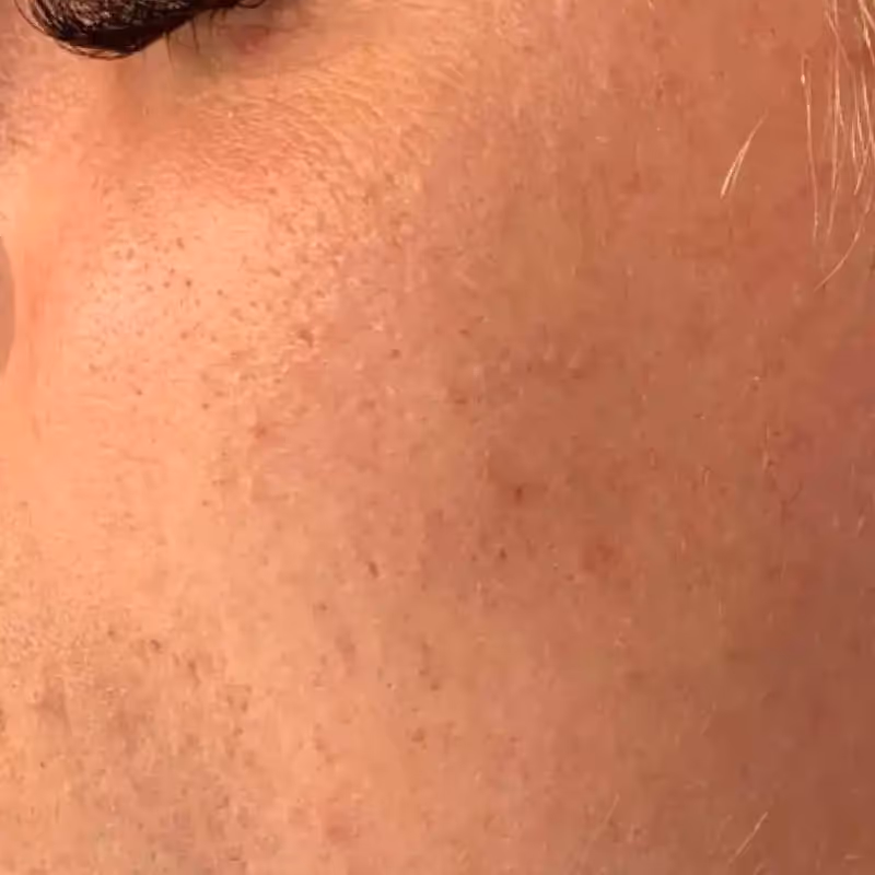 SKIN PEN 4