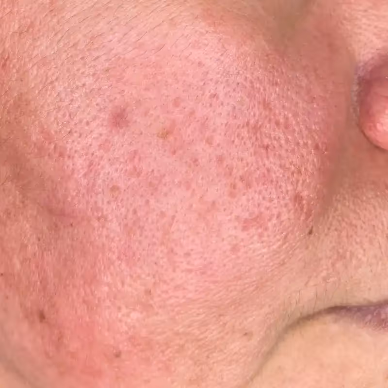 SKIN PEN 5