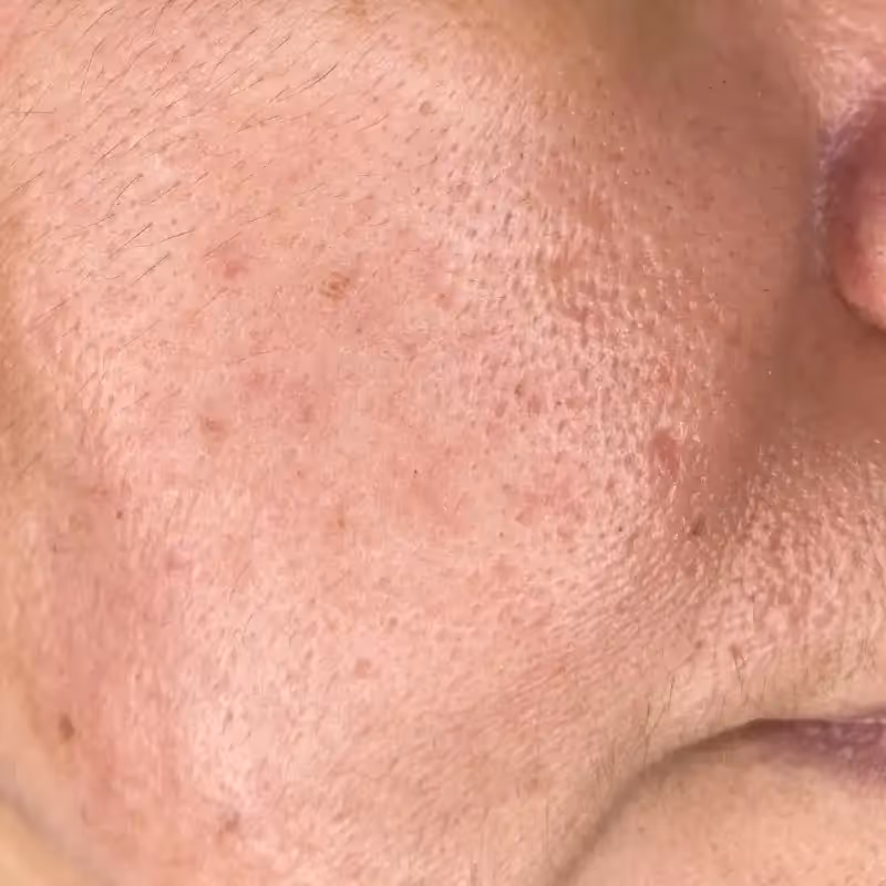 SKIN PEN 5