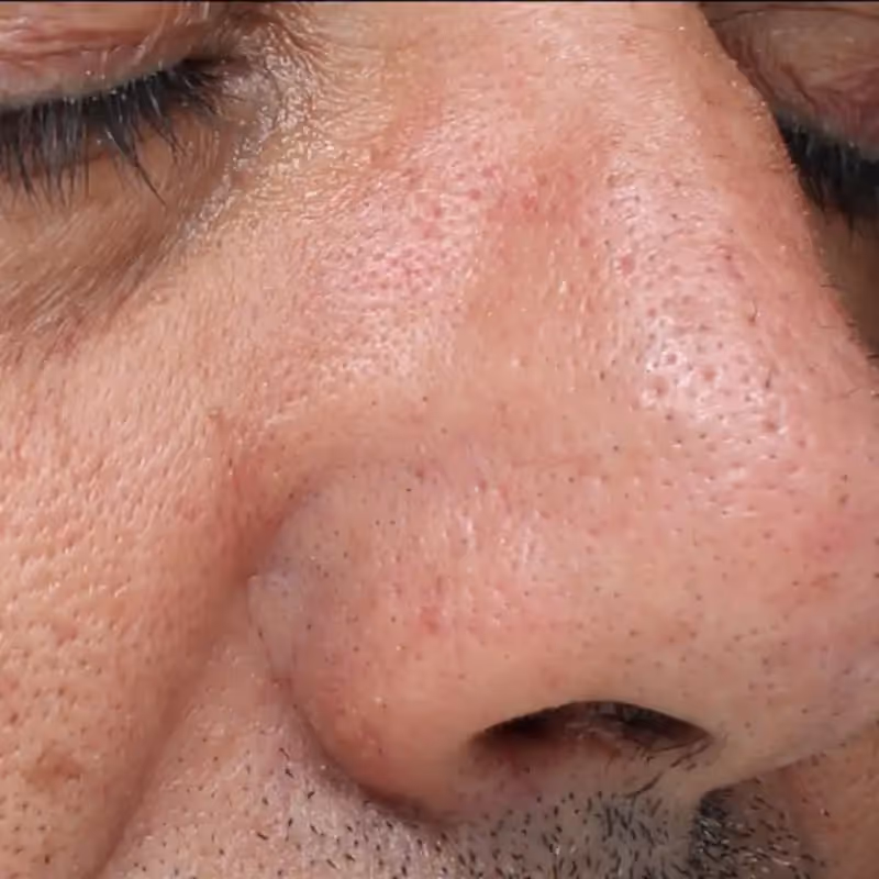 DERMACLEAR ALMA 1