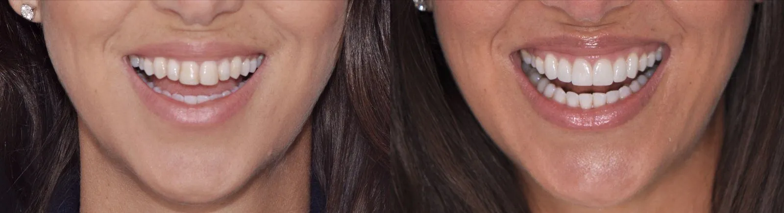 Smile House veneers patient, before and after