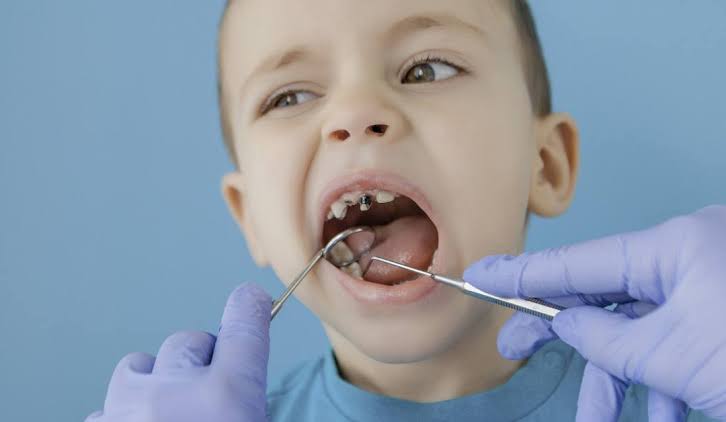 Pediatric Pulpotomies