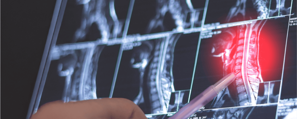 AI integration highlighting spinal abnormality on PACS MRI scan in radiology workflo