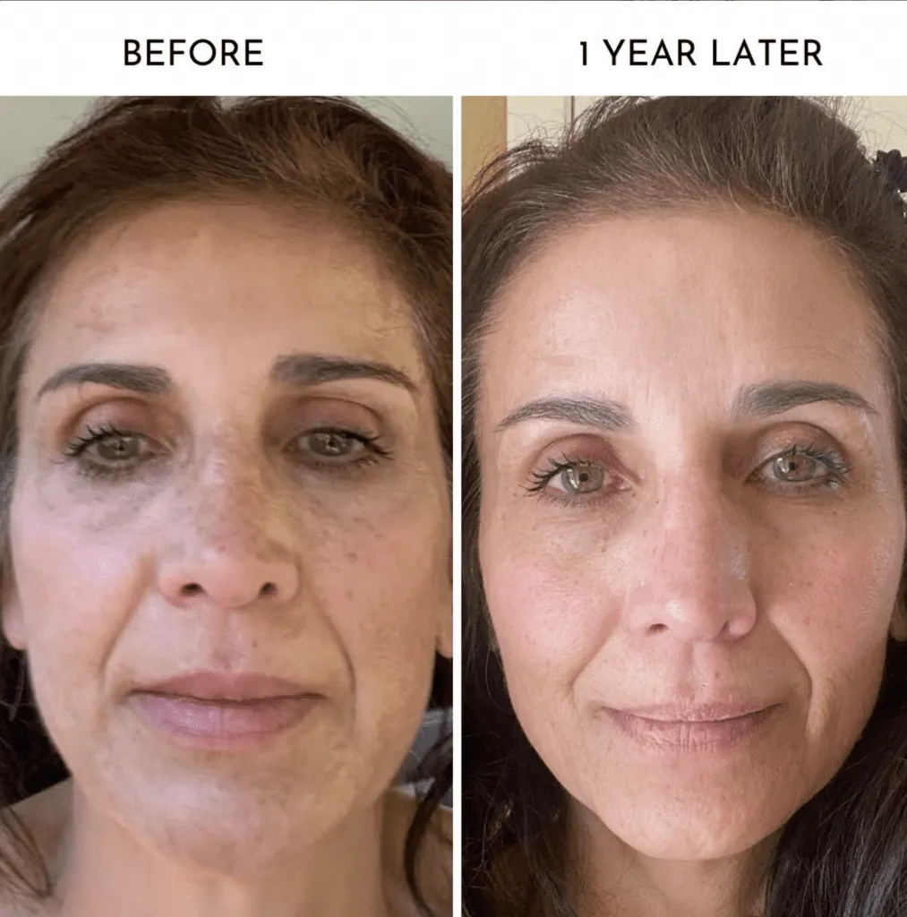 Microneedling