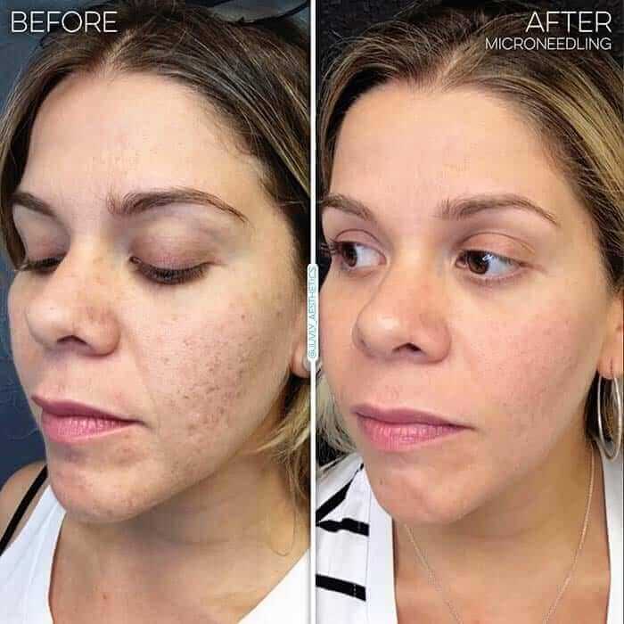 Microneedling