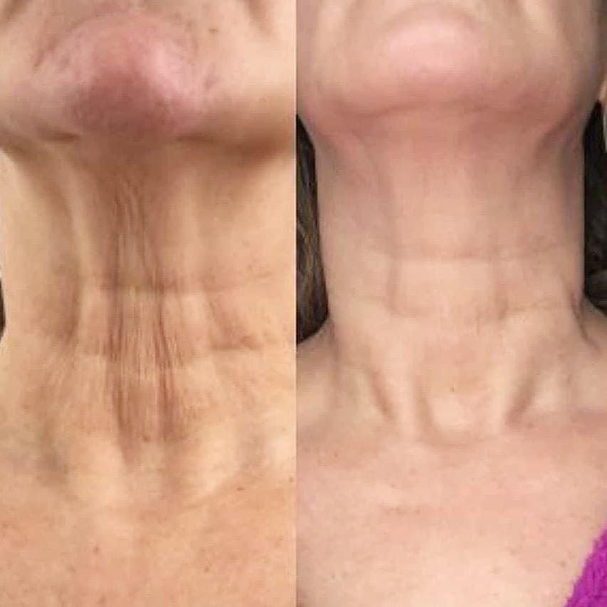Plasma Fibroblast Treatments