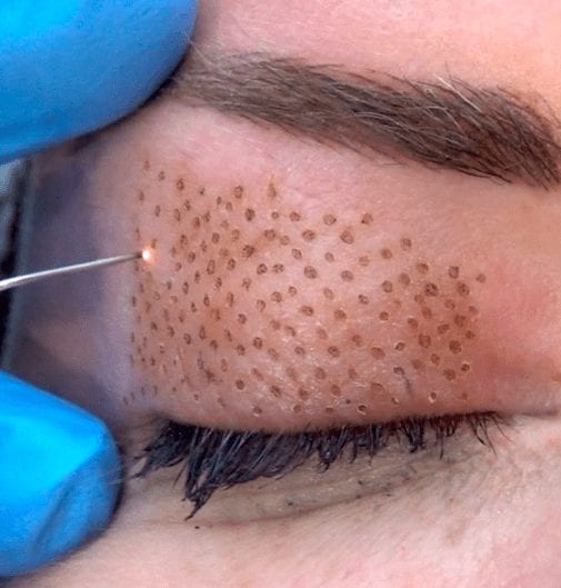 Plasma Fibroblast Treatments