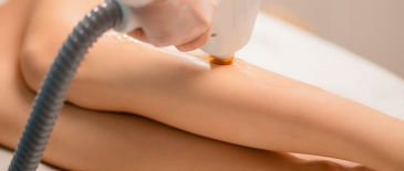 A woman getting the x-large laser areas treatment on her leg