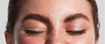 The area at the root of the nose where the frown marks would be removed