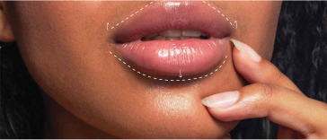 Lip augmentation on a woman's face